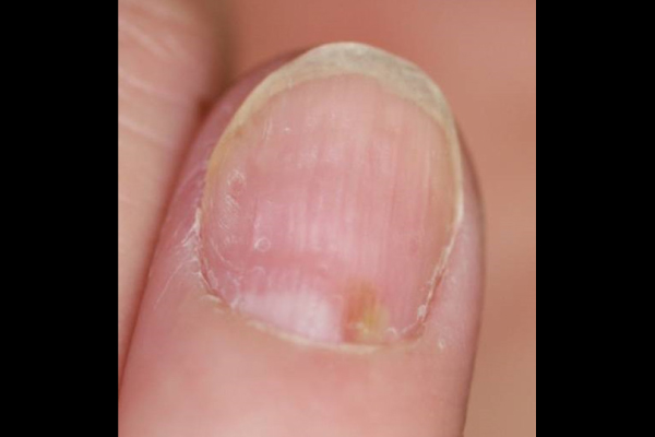 Pustules under nail plate