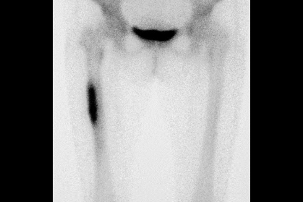 bone scintigraphy