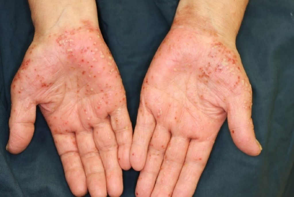 手のひら が かゆい 湿疹 なし 手のひらのぶつぶつがかゆいし痛い 赤い水泡や湿疹の原因は病気 高齢者のための役立ち情報ブログ ３歩進んで２歩下がる